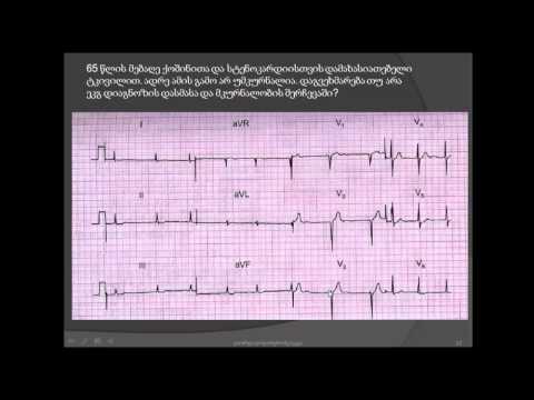 ეკგ / წინაგულების ფიბრილაცია და გულის ინფარქტი /  დისპნოე და გულის არეში ტკივილი